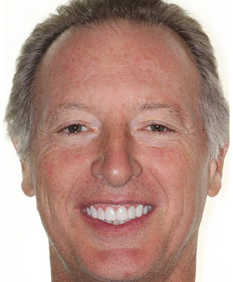 Dental Crowns Before After