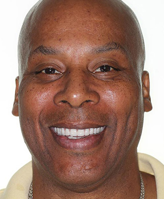 Full Mouth Reconstruction