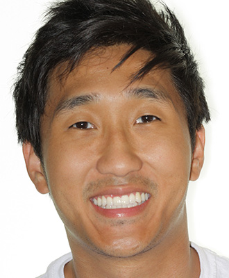 Invisalign Before After
