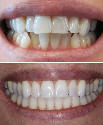 Invisalign Before After