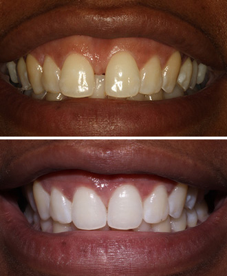 Invisalign Before After