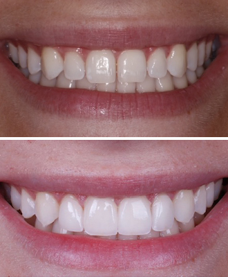 Porcelain Veneers Before After