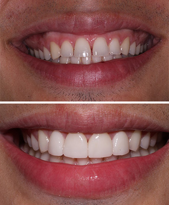 Porcelain Veneers Before After