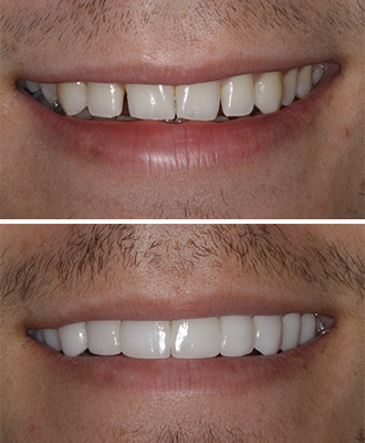 Porcelain Veneers Before After