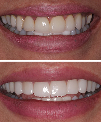 Porcelain Veneers Before After