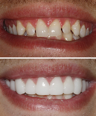 Porcelain Veneers Before After