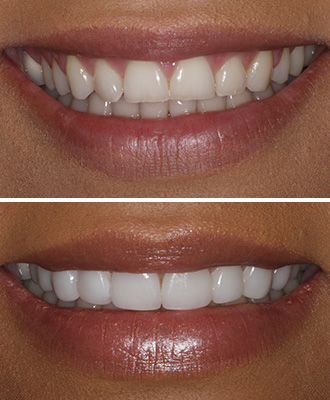 Porcelain Veneers Before After