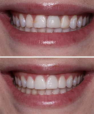 Porcelain Veneers Before After