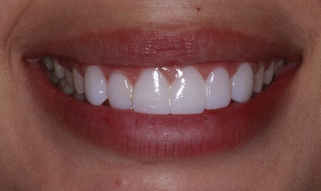 smile-test-drive-noela-after