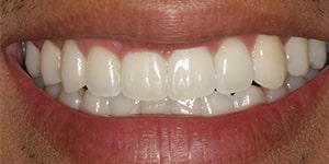 mouth-after