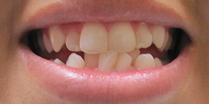 mouth-before-invisalign