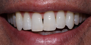 mouth-after-invisalign
