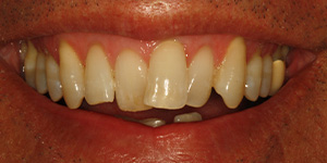 mouth-before-invisalign