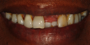 teeth-before-reconstruction