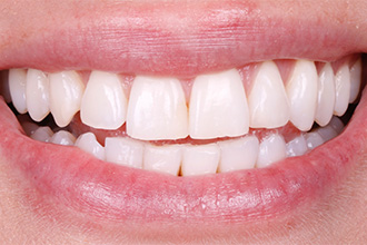 before-full-smile-veneers