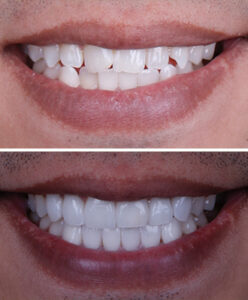 Before and After Treatment