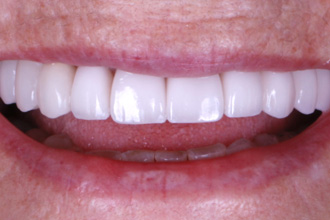 After Treatment