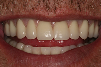 After Treatment
