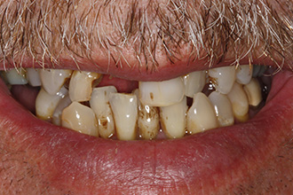 Before Treatment