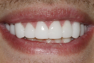 After Treatment