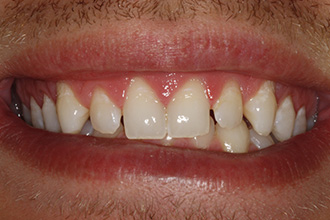 Before Treatment