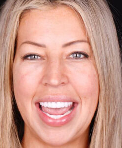 A Whitening, Invisalign, veneers Full After