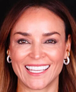 E Invisalign, whitening and veneers Full After