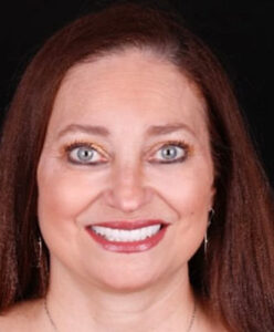 F Invisalign, crowns and veneers Full After